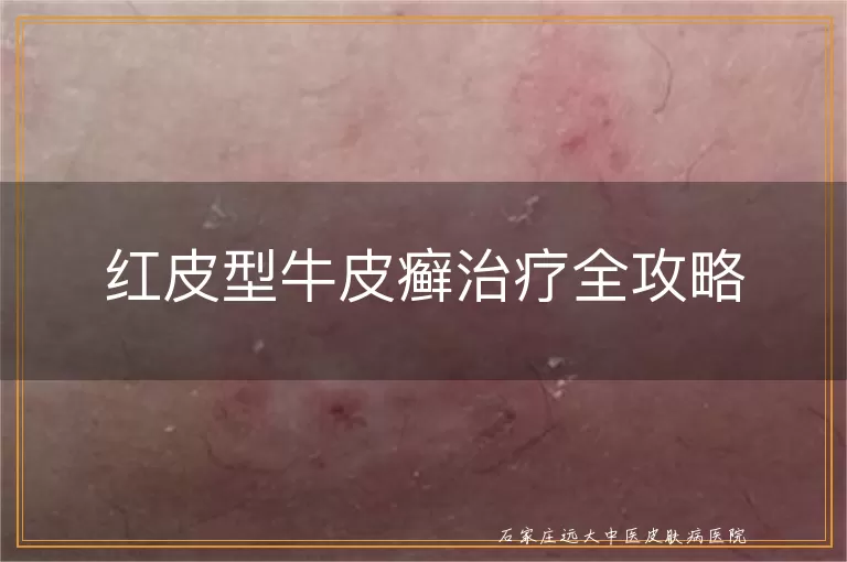 红皮型牛皮癣治疗全攻略