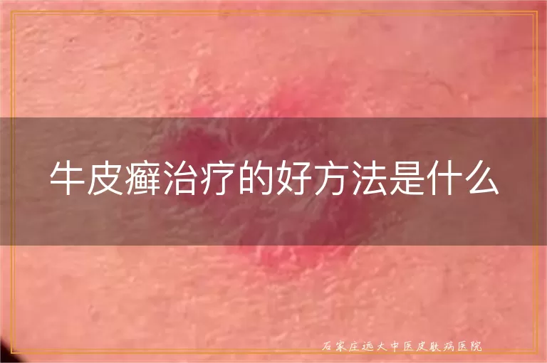 牛皮癣治疗的好方法是什么