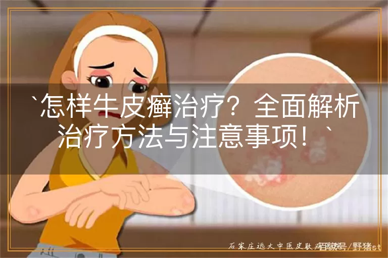 怎样牛皮癣治疗?全面解析治疗方法与注意事项!