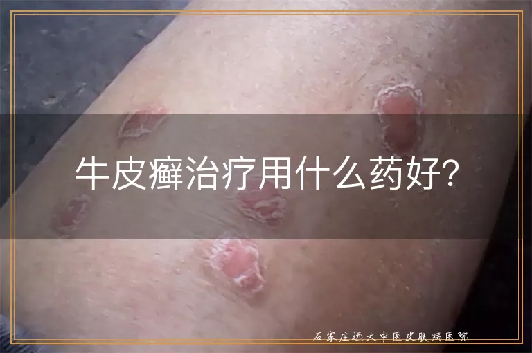 牛皮癣治疗用什么药好?