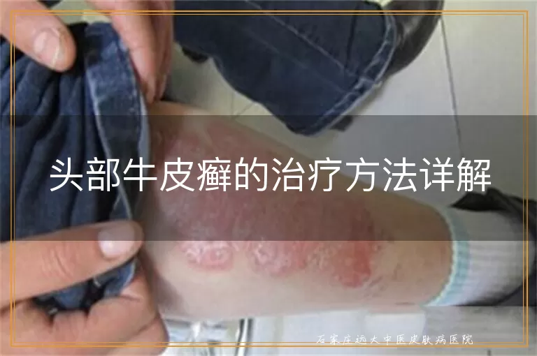 头部牛皮癣的治疗方法详解