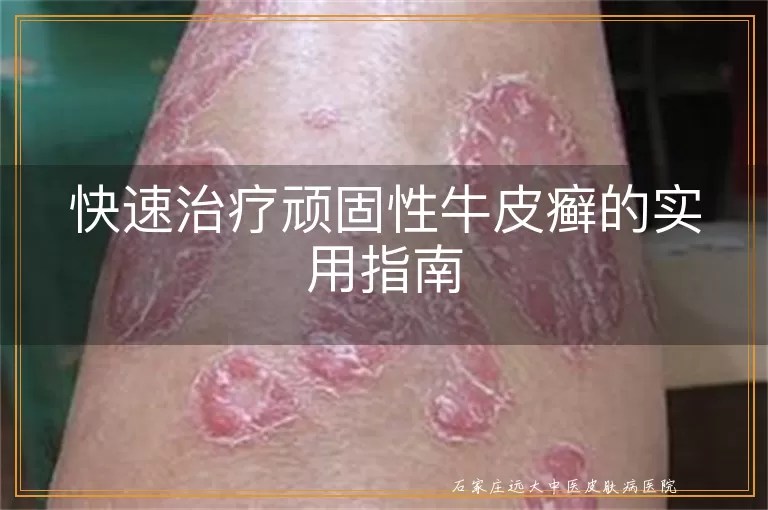 快速治疗顽固性牛皮癣的实用指南