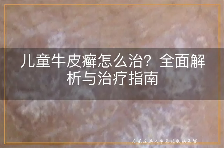 儿童牛皮癣怎么治?全面解析与治疗指南
