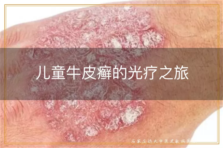 儿童牛皮癣的光疗之旅