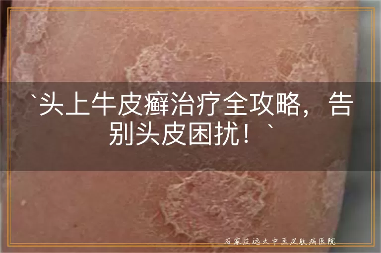 头上牛皮癣治疗全攻略,告别头皮困扰!