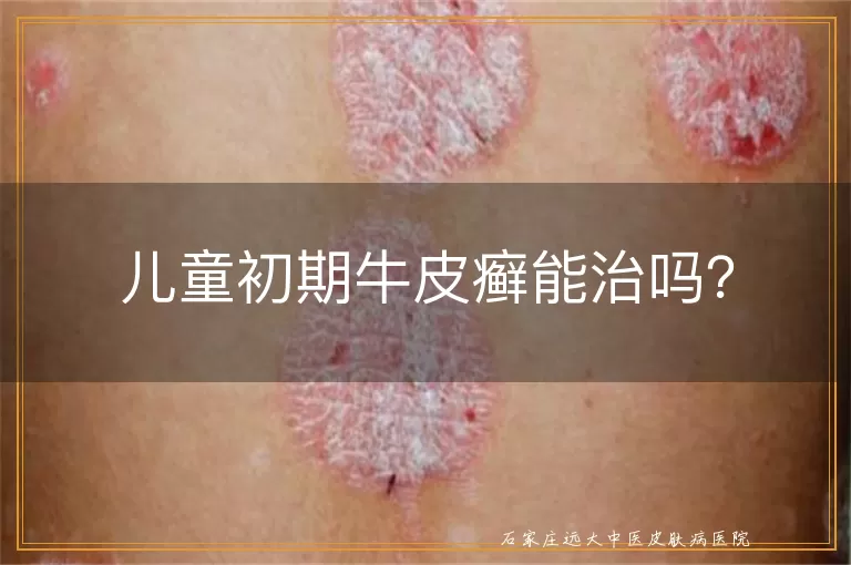 儿童初期牛皮癣能治吗?