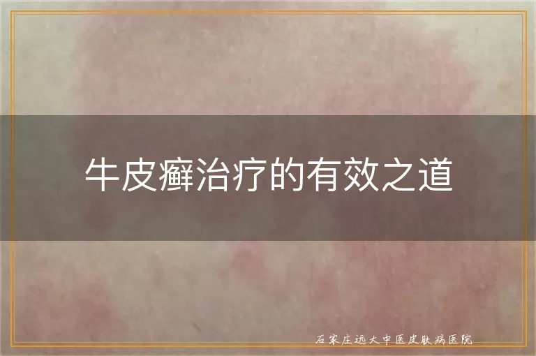 牛皮癣治疗的有效之道