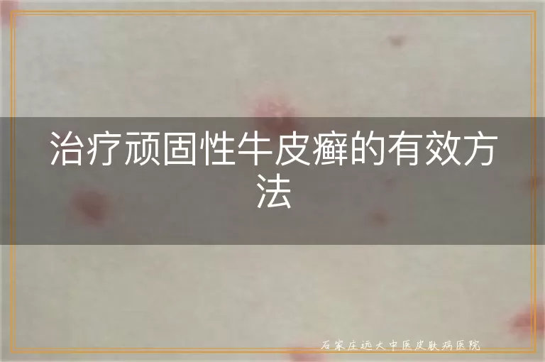 治疗顽固性牛皮癣的有效方法