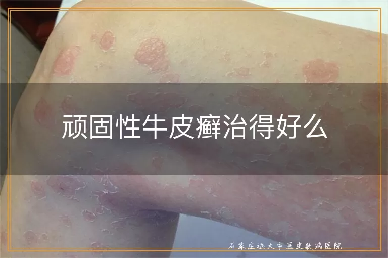 顽固性牛皮癣治得好么
