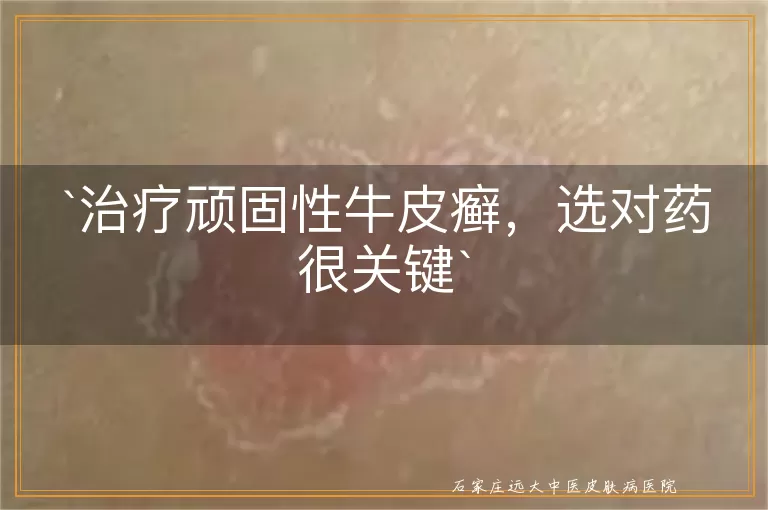 治疗顽固性牛皮癣,选对药很关键