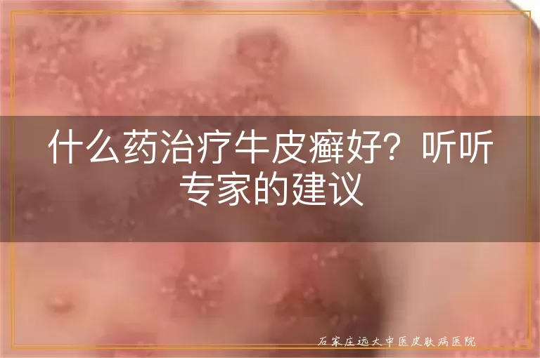 什么药治疗牛皮癣好？听听专家的建议