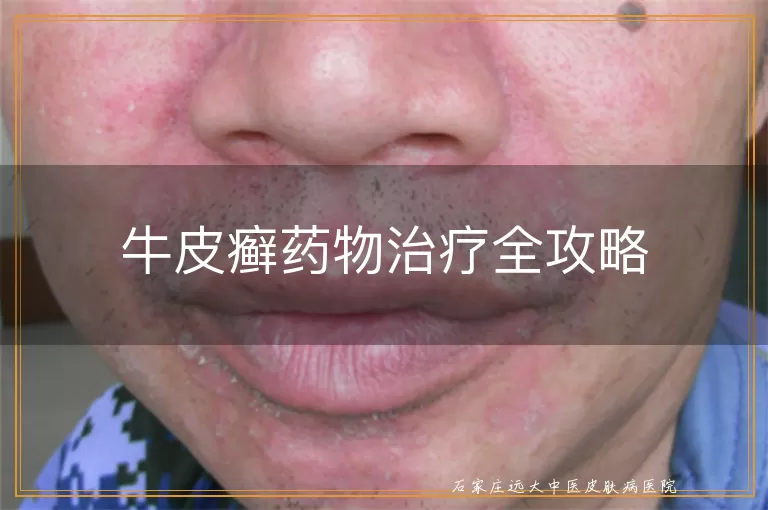 牛皮癣药物治疗全攻略