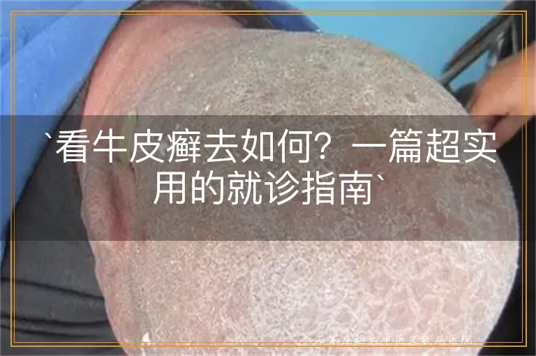 看牛皮癣去如何？一篇超实用的就诊指南