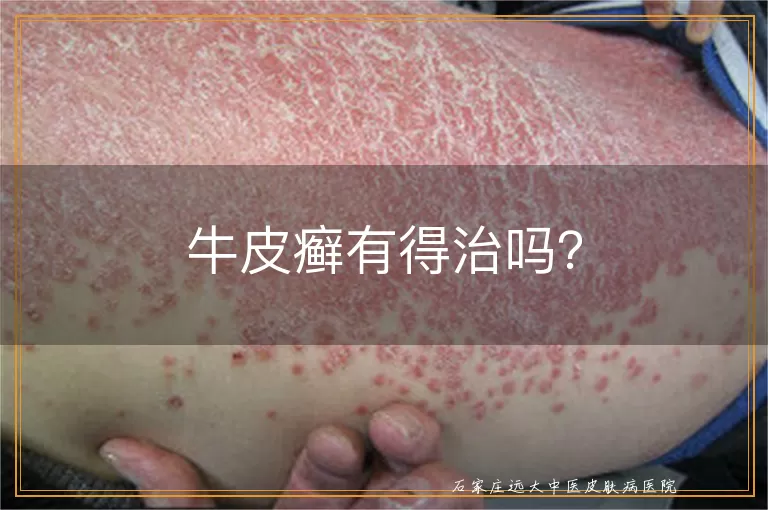 牛皮癣有得治吗？