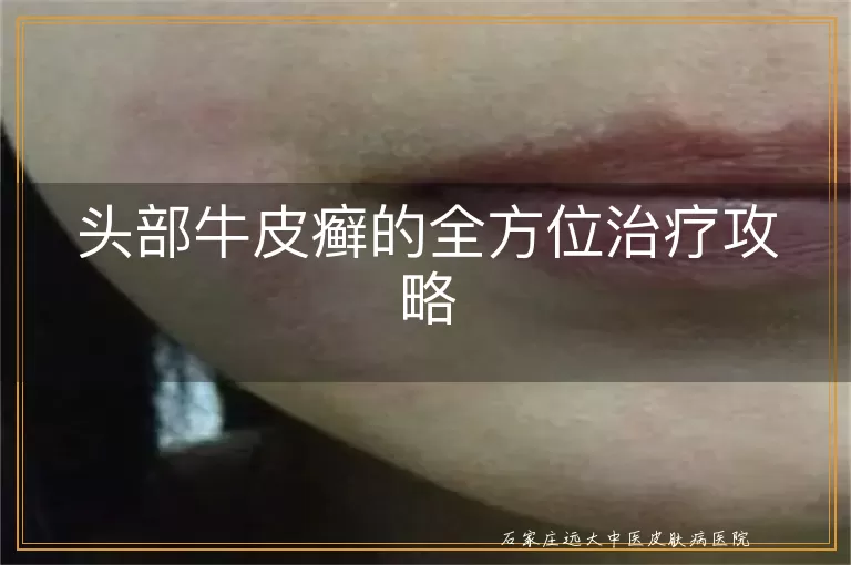 头部牛皮癣的全方位治疗攻略