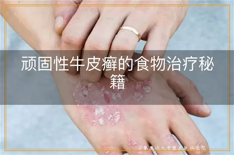 顽固性牛皮癣的食物治疗秘籍