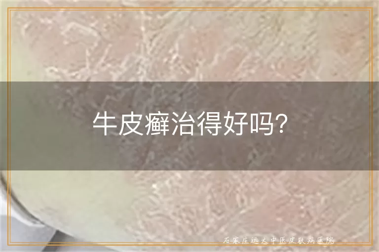 牛皮癣治得好吗？