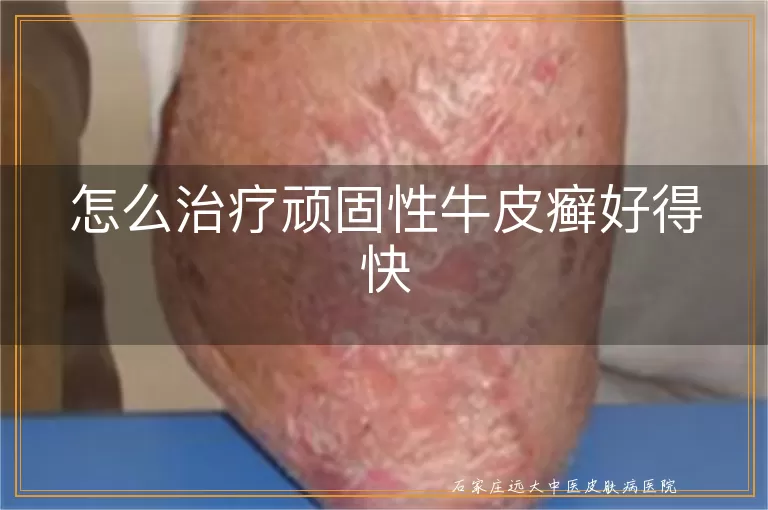 怎么治疗顽固性牛皮癣好得快