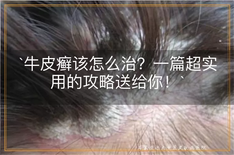 牛皮癣该怎么治?一篇超实用的攻略送给你!