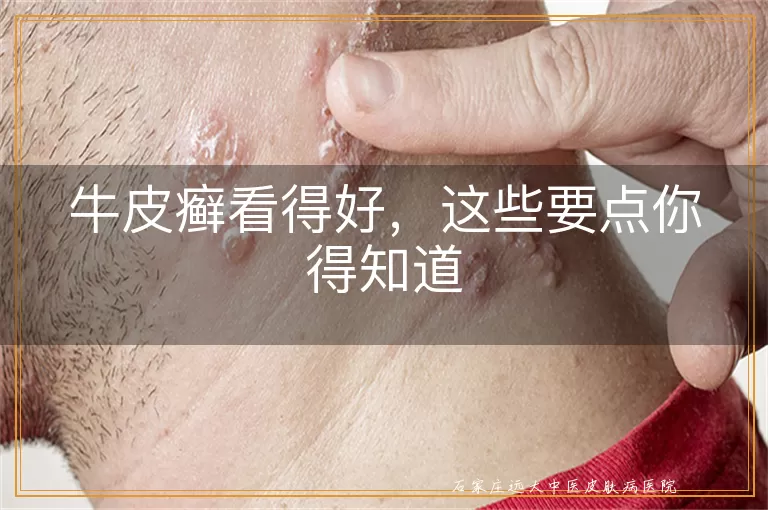 牛皮癣看得好,这些要点你得知道