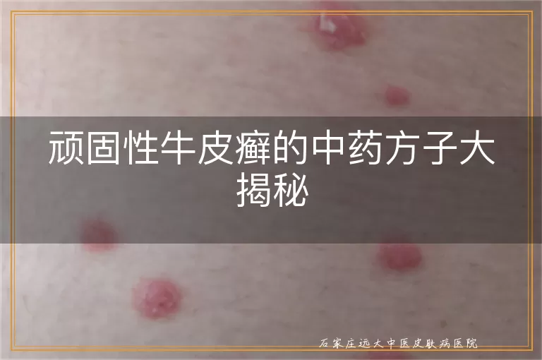 顽固性牛皮癣的中药方子大揭秘