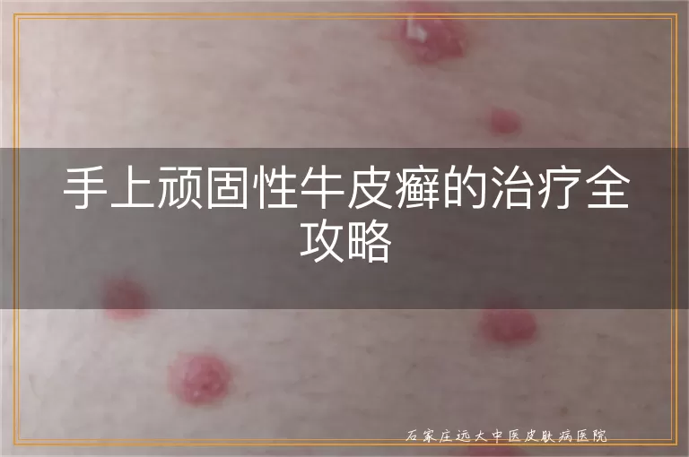手上顽固性牛皮癣的治疗全攻略
