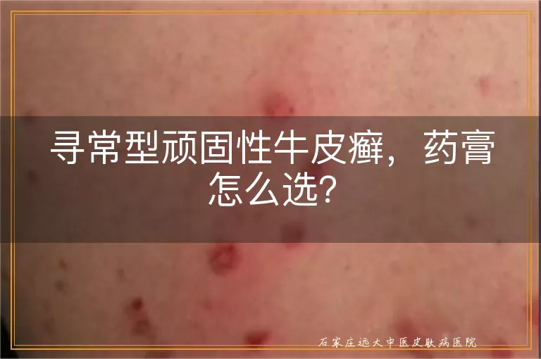 寻常型顽固性牛皮癣,药膏怎么选?