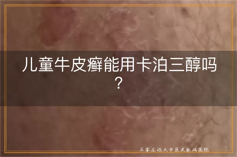 儿童牛皮癣能用卡泊三醇吗？