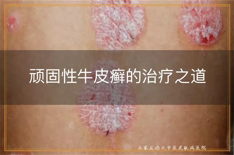 顽固性牛皮癣的治疗之道