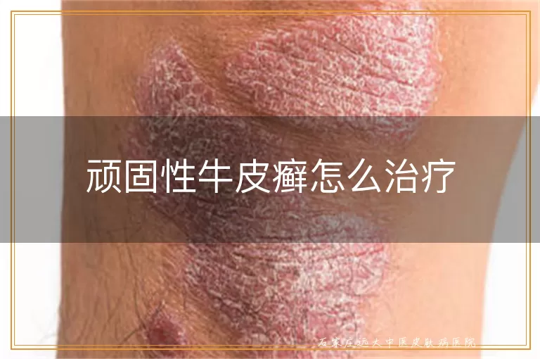 顽固性牛皮癣怎么治疗
