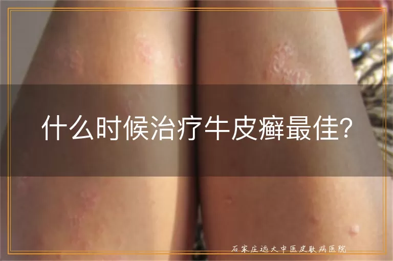 什么时候治疗牛皮癣最佳？