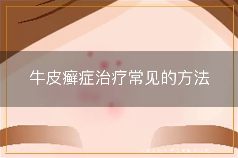 牛皮癣症治疗常见的方法