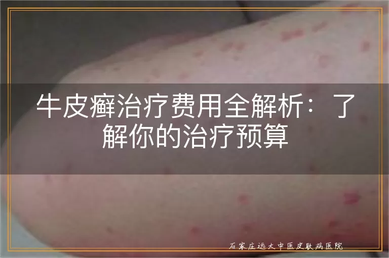 牛皮癣治疗费用全解析：了解你的治疗预算