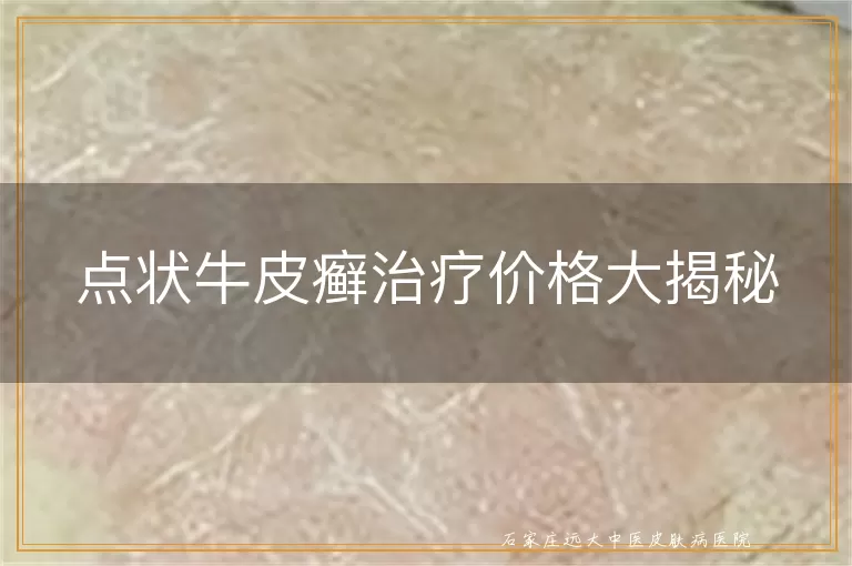 点状牛皮癣治疗价格大揭秘