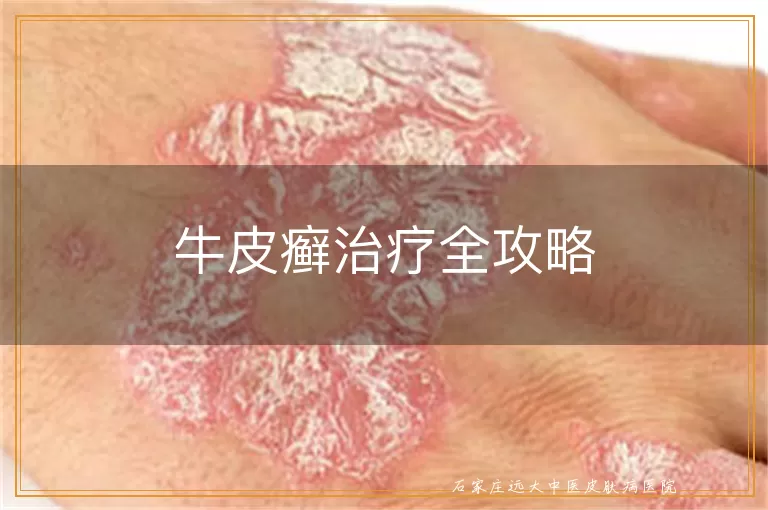 牛皮癣治疗全攻略