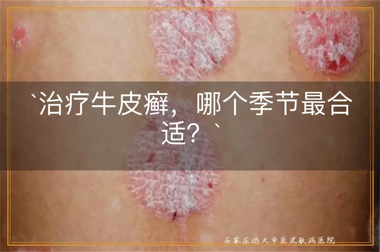 治疗牛皮癣,哪个季节最合适?