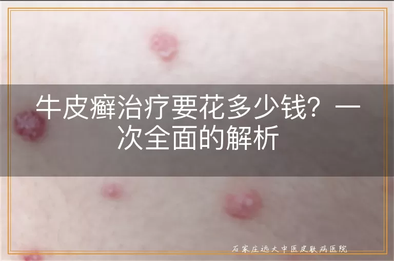 牛皮癣治疗要花多少钱?一次全面的解析
