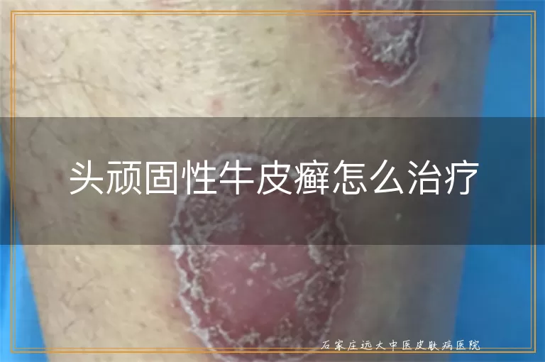 头顽固性牛皮癣怎么治疗