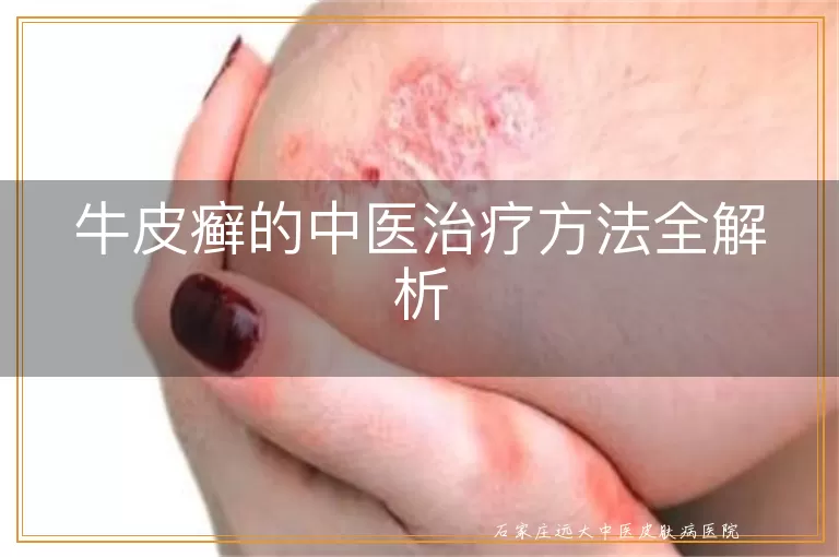 牛皮癣的中医治疗方法全解析
