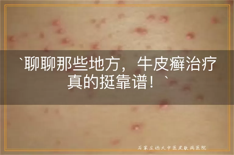 聊聊那些地方，牛皮癣治疗真的挺靠谱！