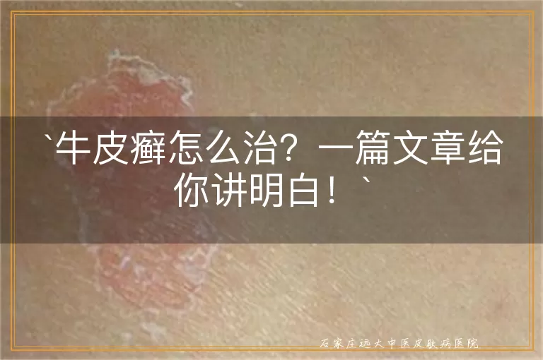 牛皮癣怎么治？一篇文章给你讲明白！