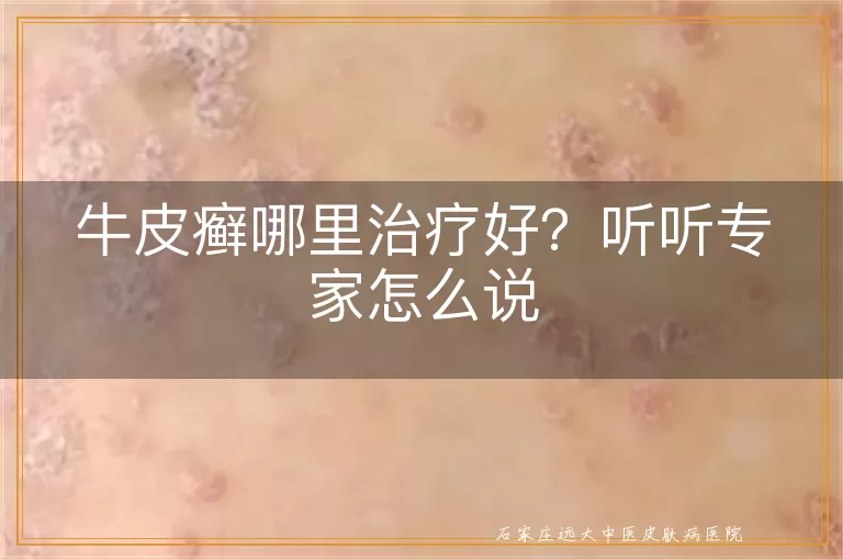 牛皮癣哪里治疗好？听听专家怎么说