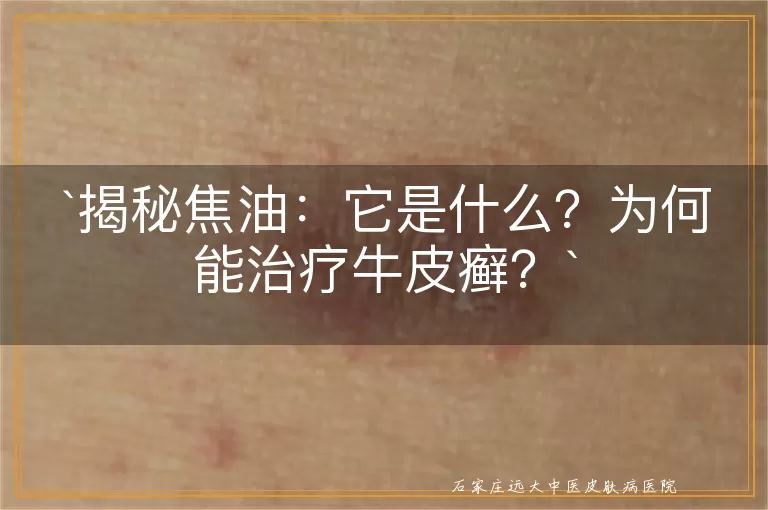 揭秘焦油:它是什么?为何能治疗牛皮癣?
