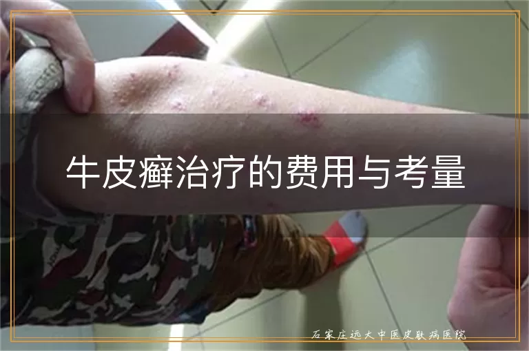 牛皮癣治疗的费用与考量