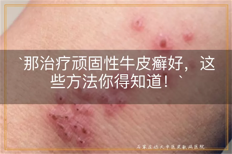 那治疗顽固性牛皮癣好，这些方法你得知道！