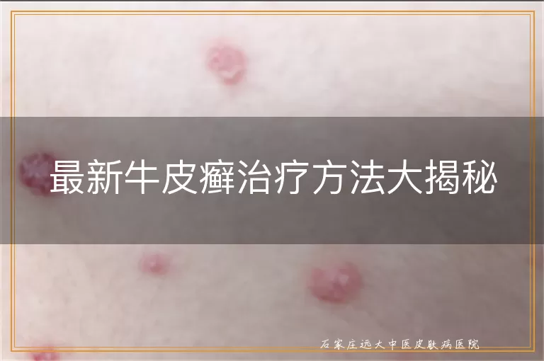 最新牛皮癣治疗方法大揭秘