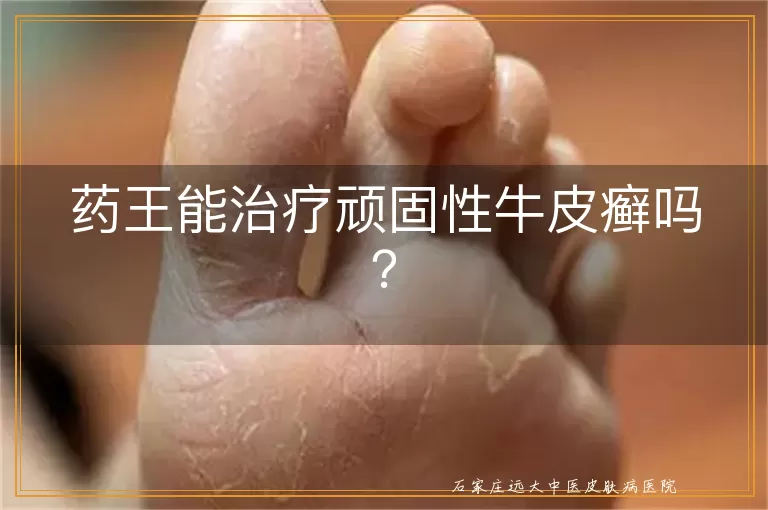 药王能治疗顽固性牛皮癣吗？