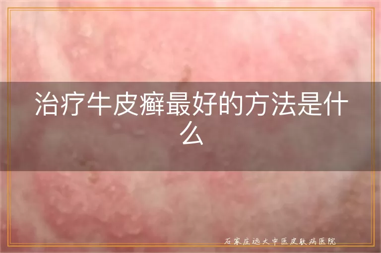 治疗牛皮癣最好的方法是什么
