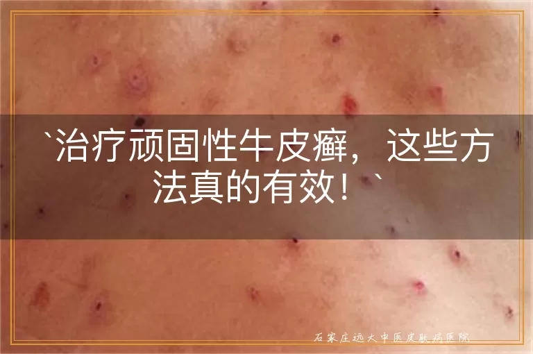 治疗顽固性牛皮癣,这些方法真的有效!