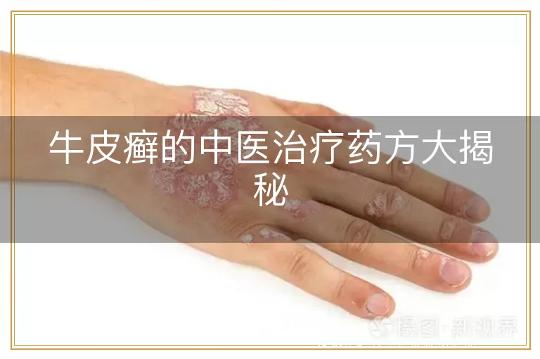 牛皮癣的中医治疗药方大揭秘